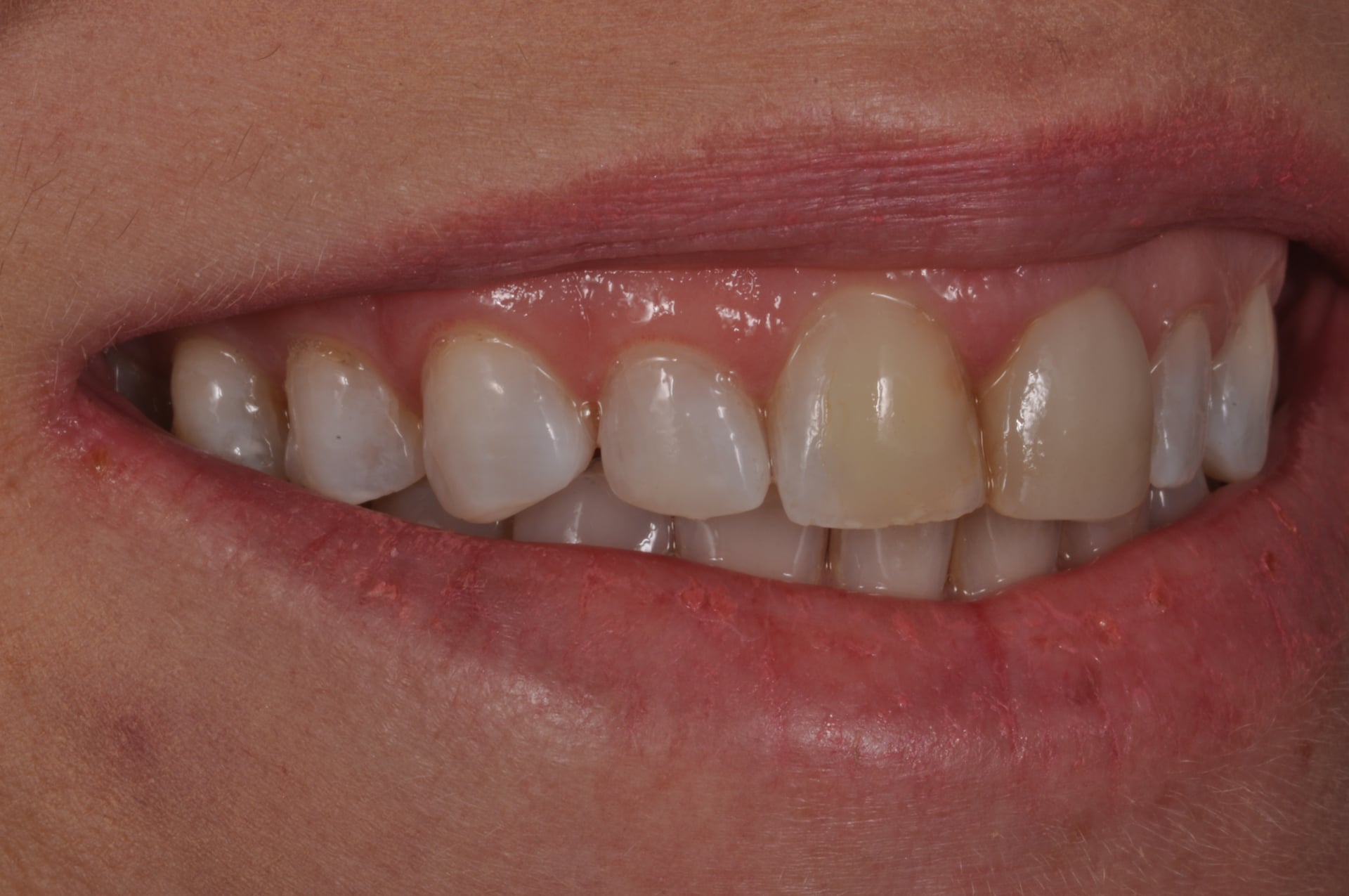 After — Anterior Cosmetic Smile Treatment