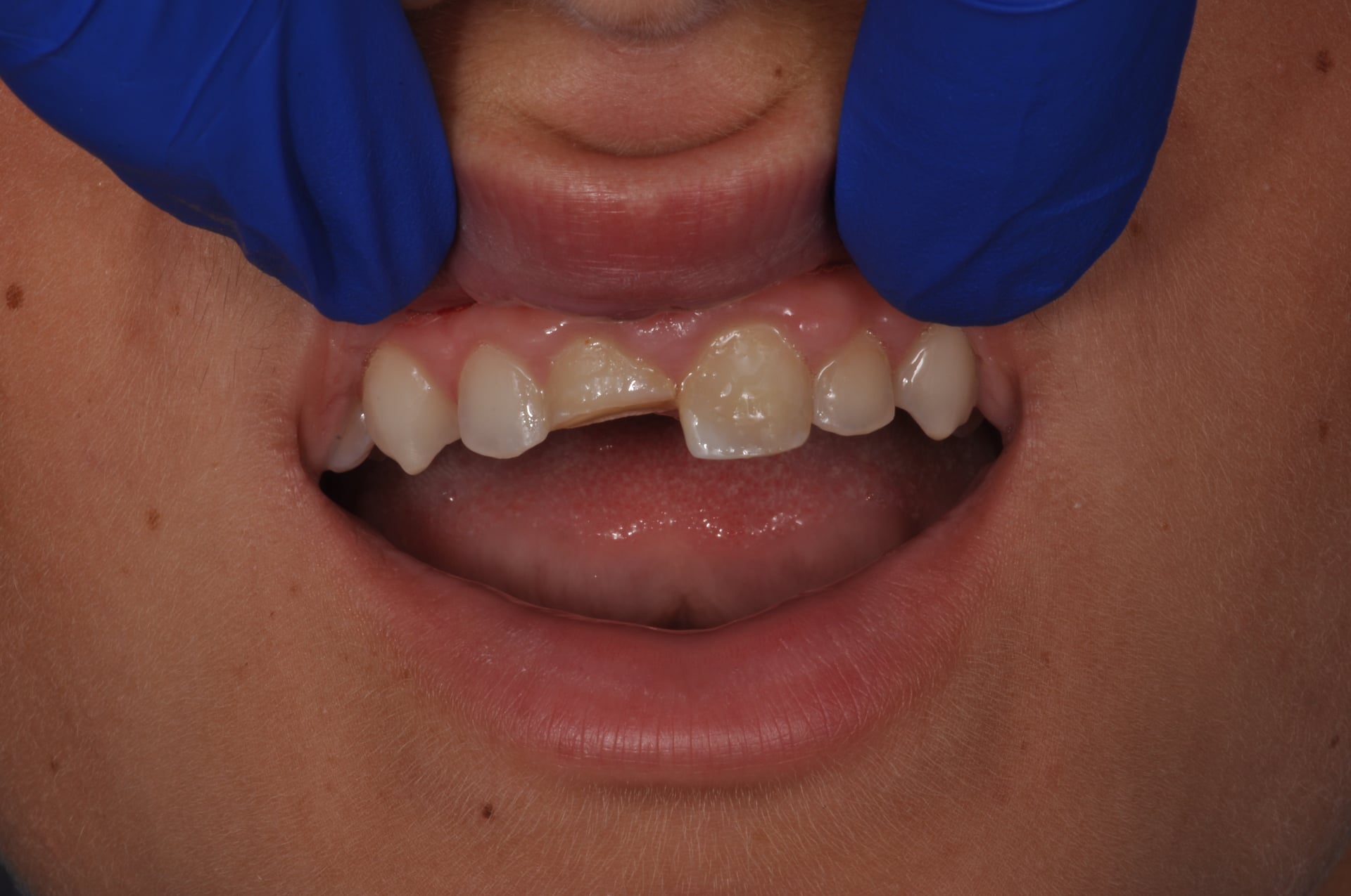 Before — Cosmetic Bonding for Chipped Front Tooth