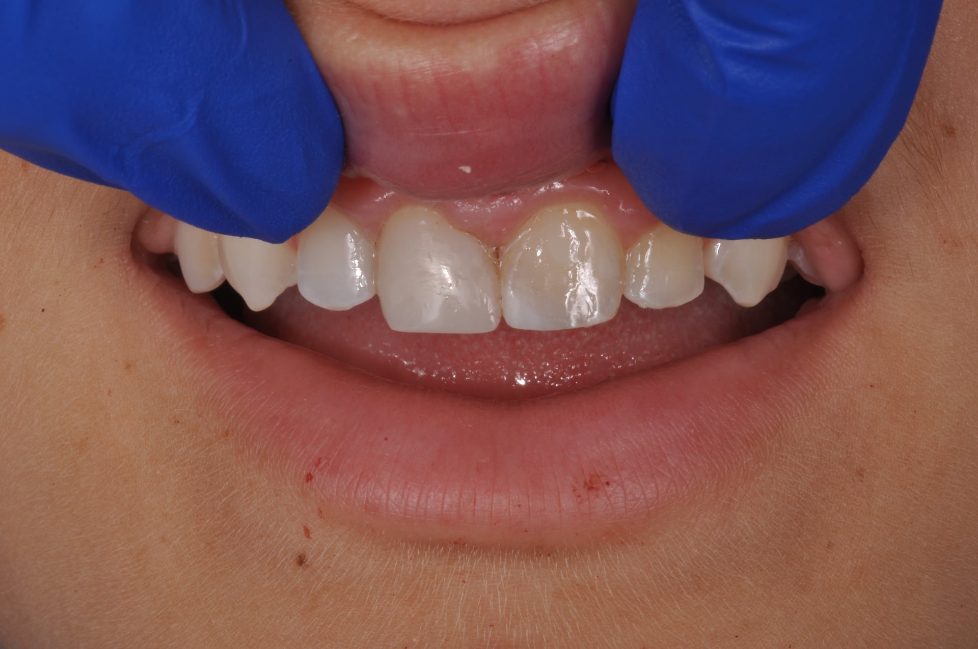 After — Cosmetic Bonding for Chipped Front Tooth