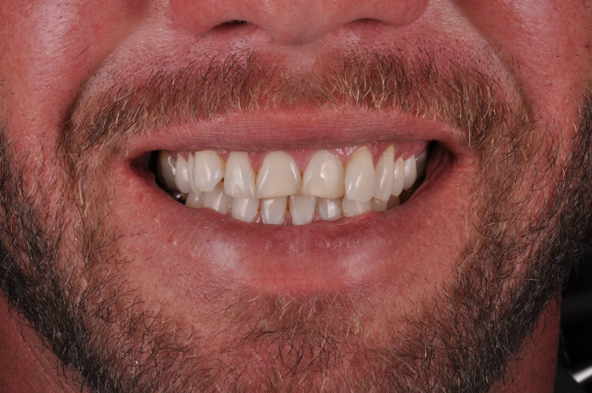 Before — Upper Arch Porcelain Veneers