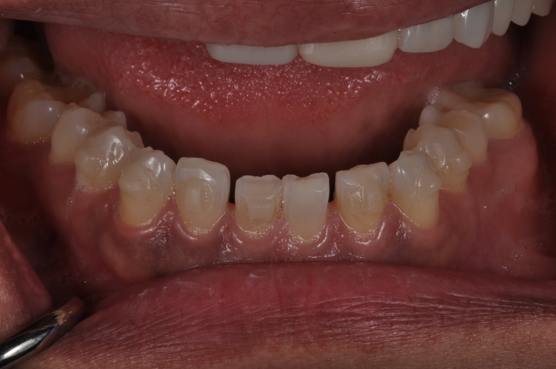 Before — Lower Arch Porcelain Veneers