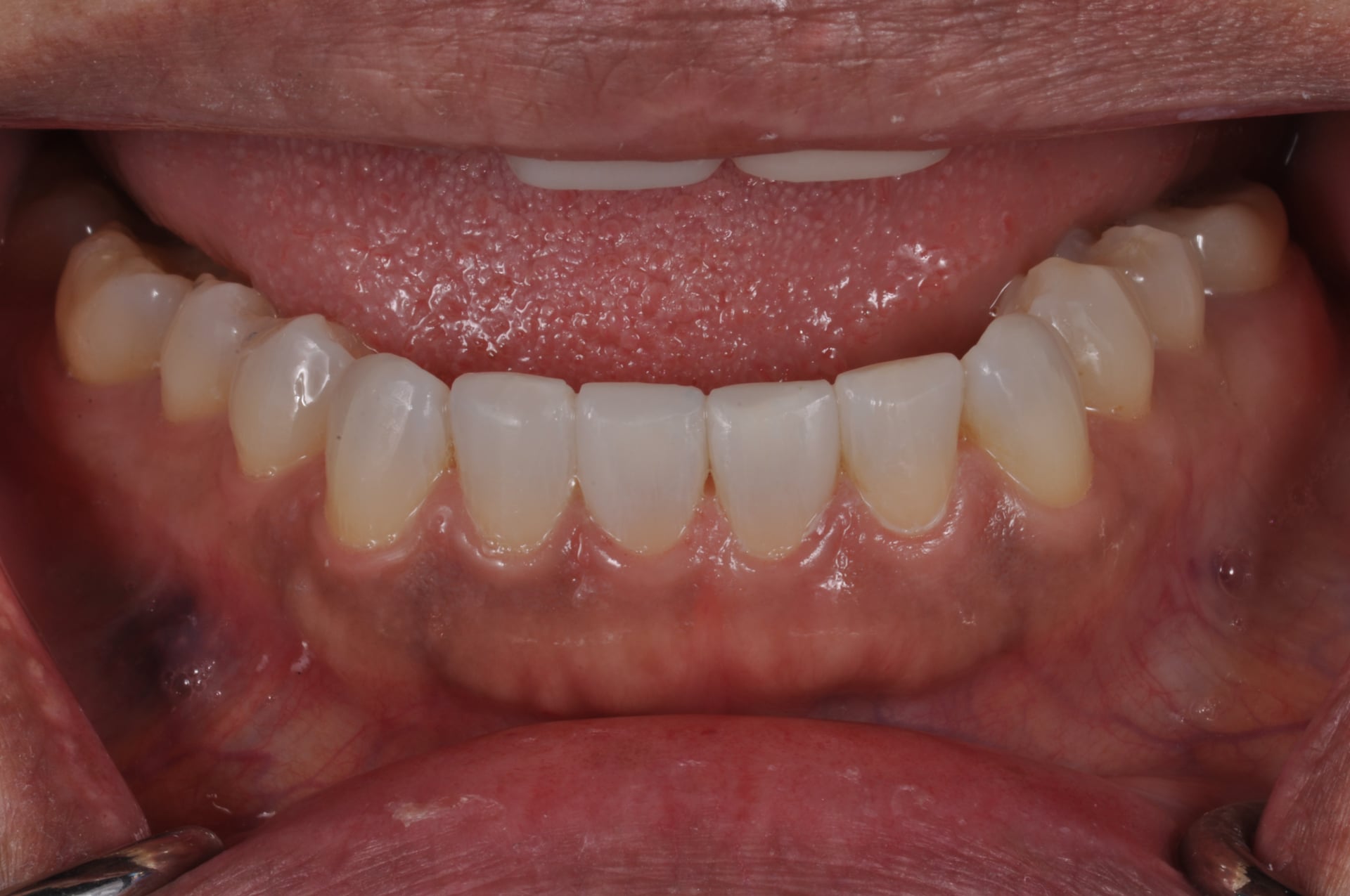 After — Lower Arch Porcelain Veneers