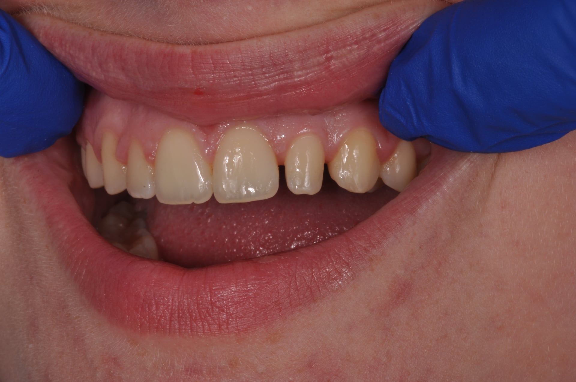 Before — Peg Lateral Incisor Veneer