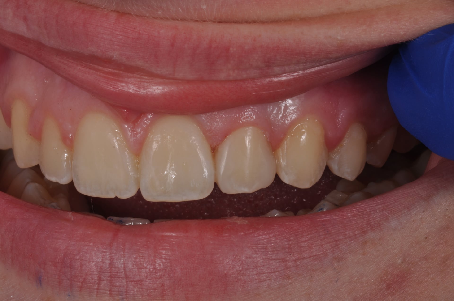 After — Peg Lateral Incisor Veneer