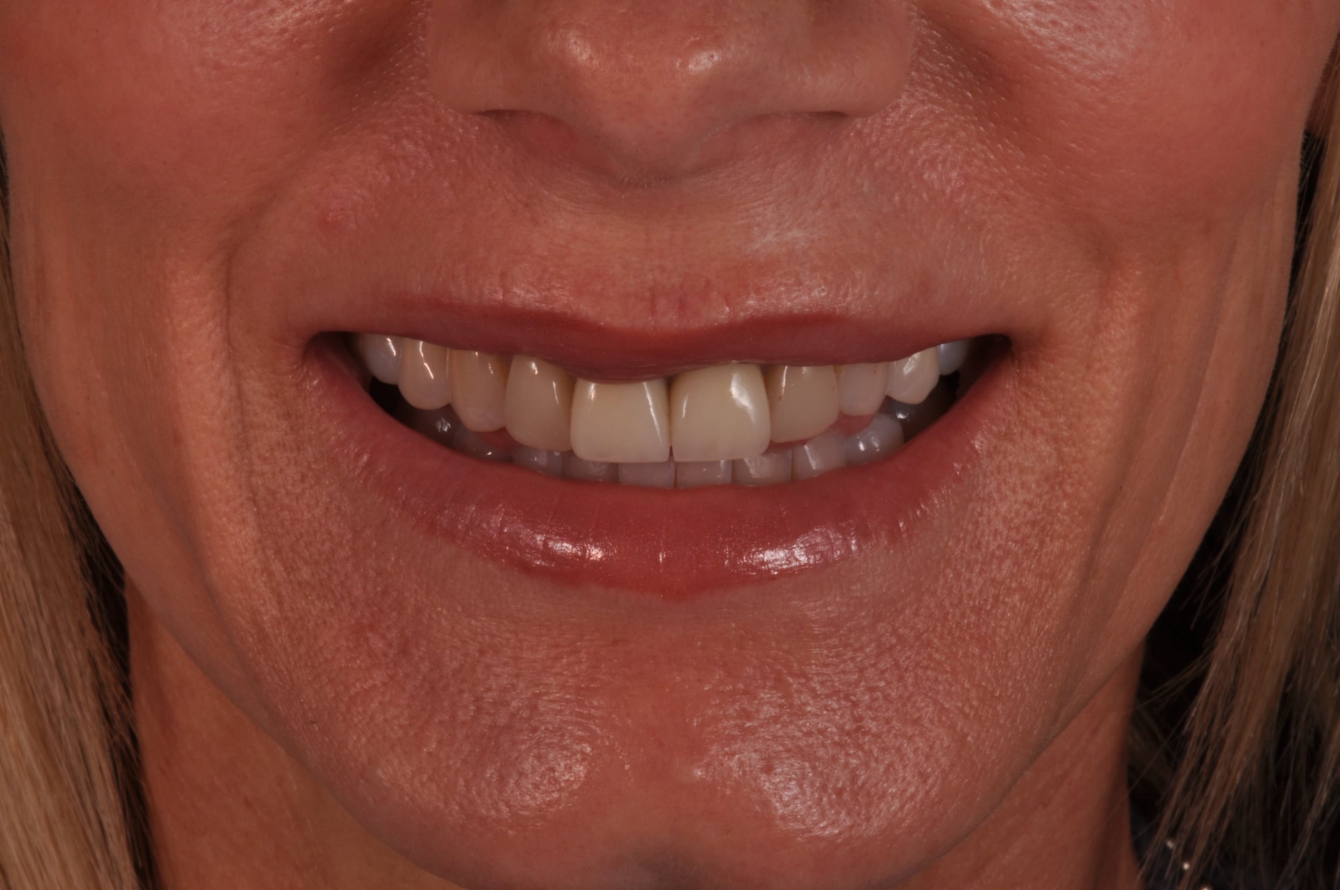 Before — Porcelain Veneer Smile Makeover