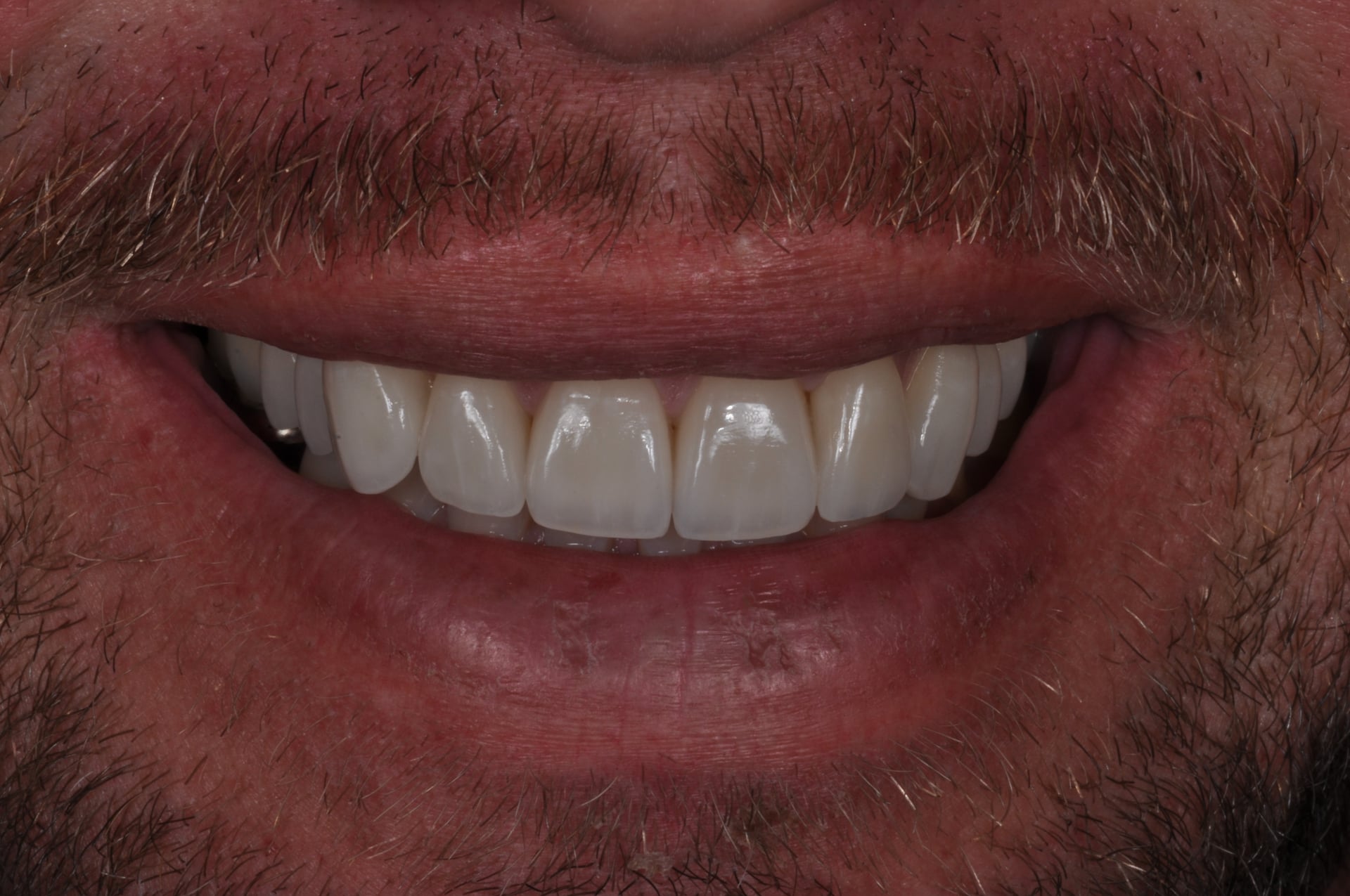 After — Upper Arch Porcelain Veneers
