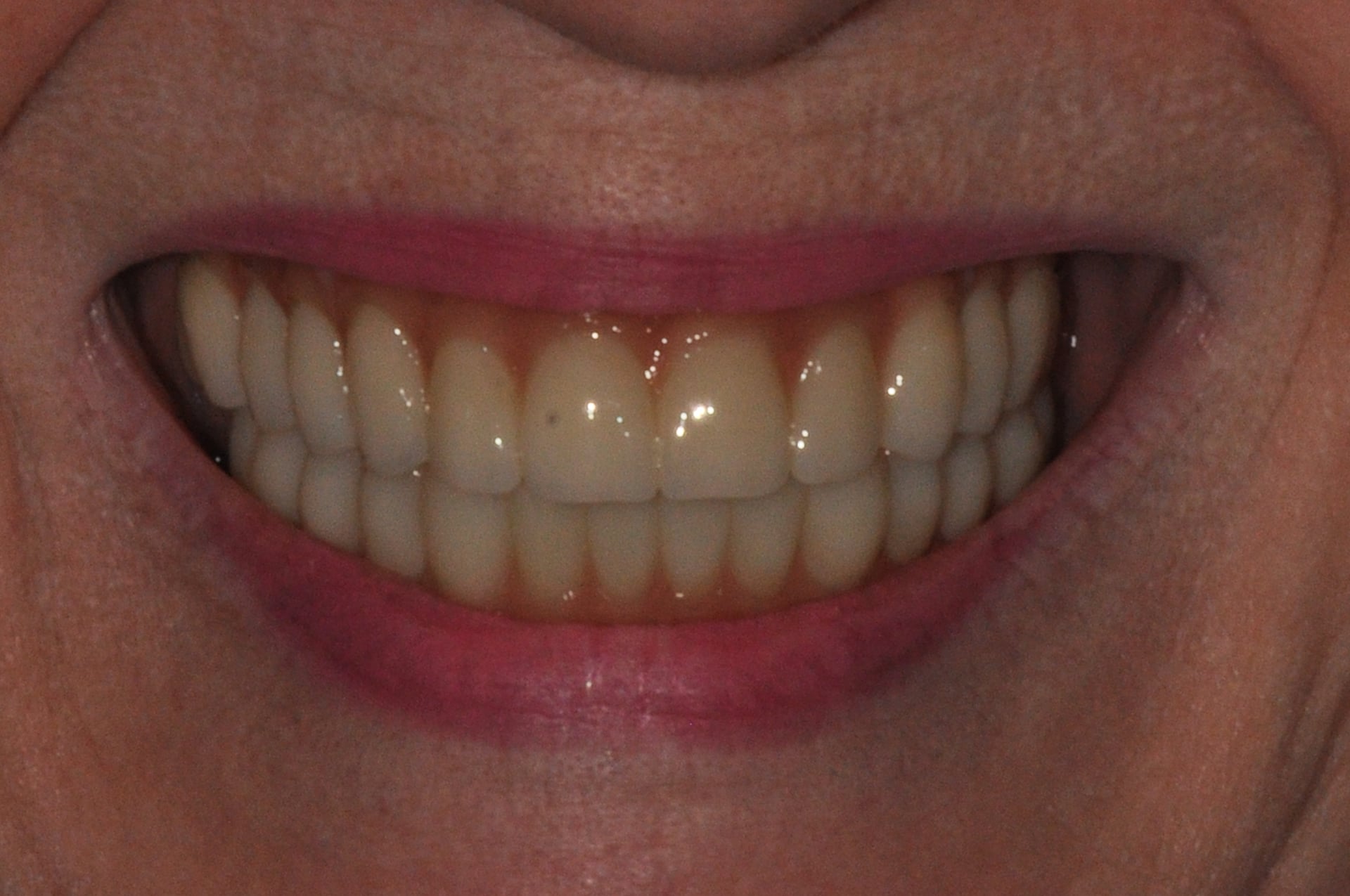 After — Custom Complete Denture Smile Restoration