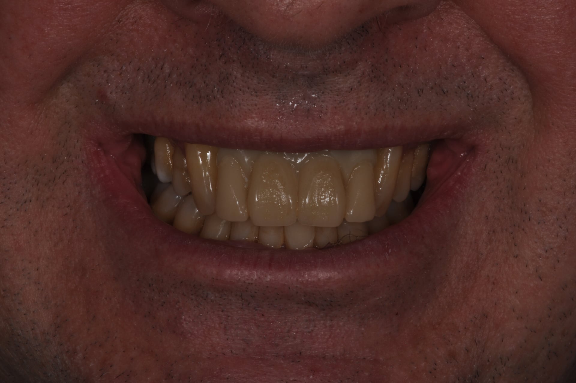 Before — Porcelain Veneer Smile Makeover