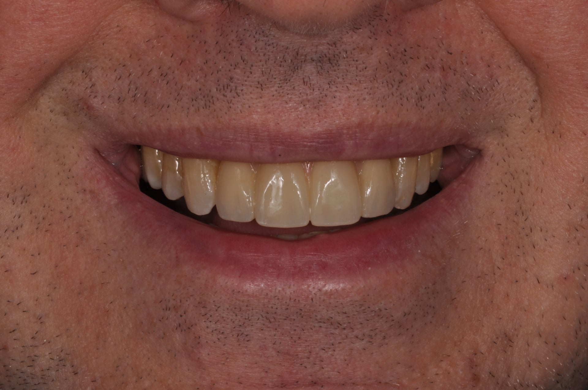 After — Porcelain Veneer Smile Makeover