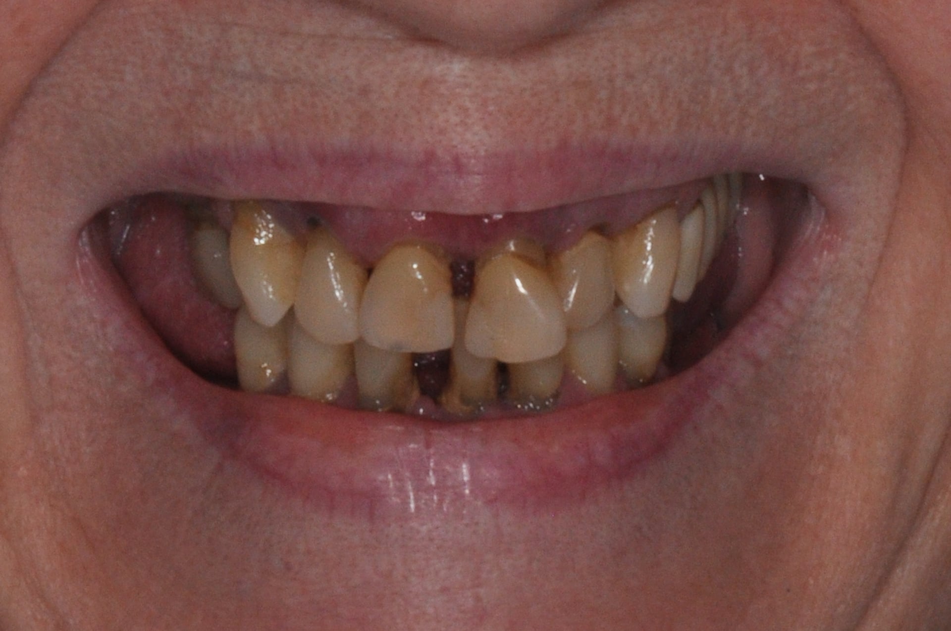 Before — Custom Complete Denture Smile Restoration