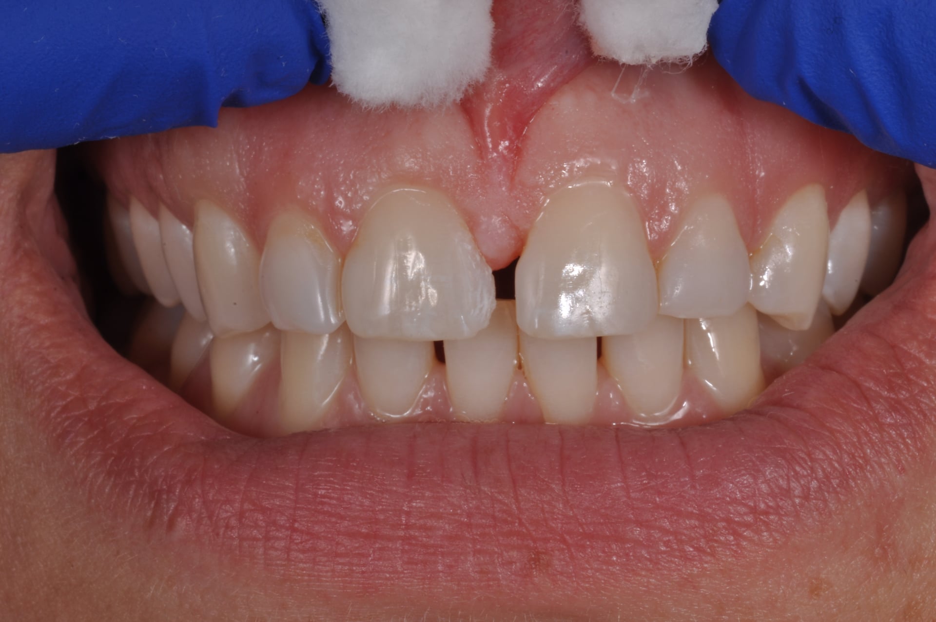 Before — Cosmetic Bonding for Diastema Closure