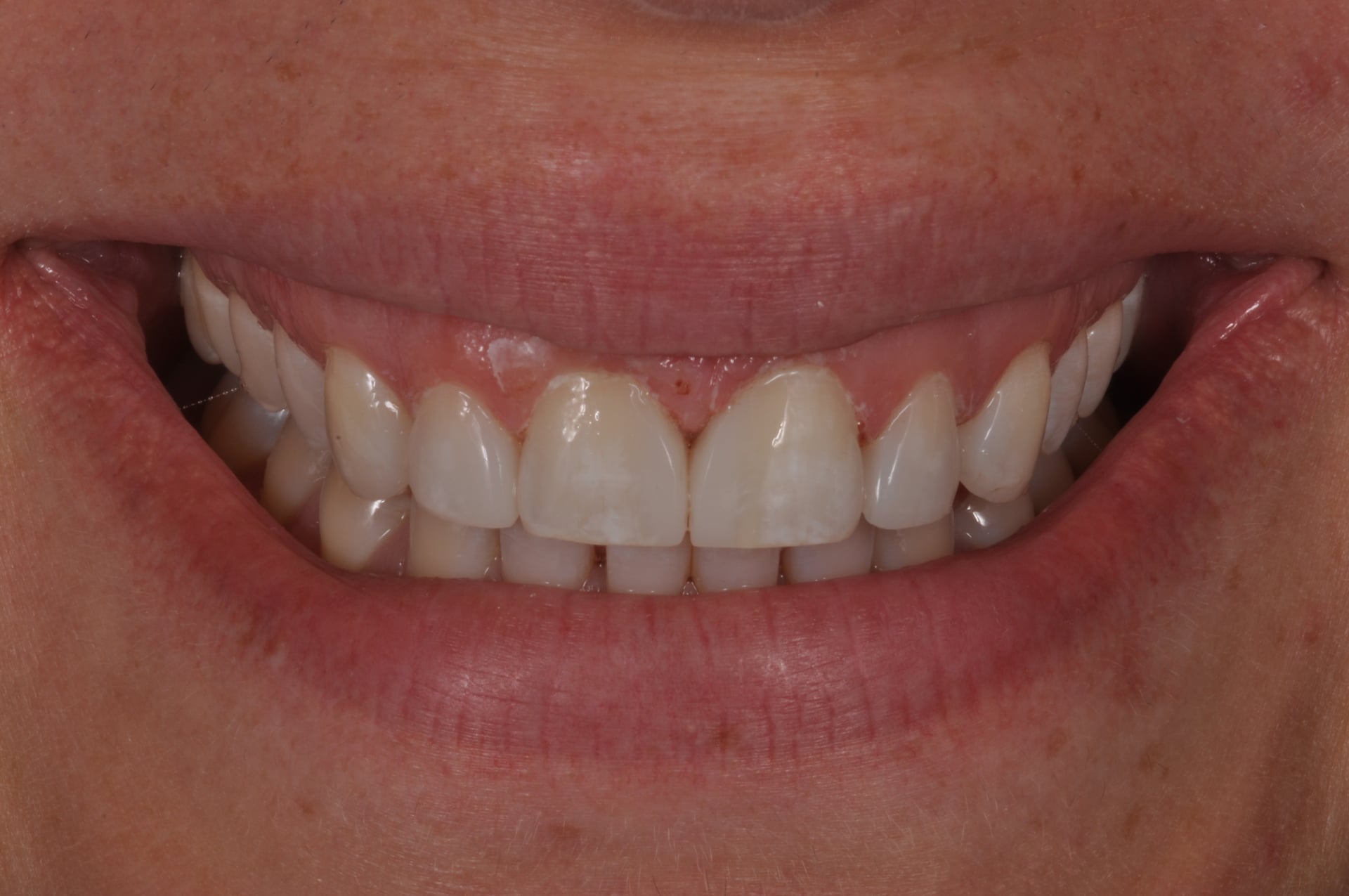 After — Cosmetic Bonding for Diastema Closure