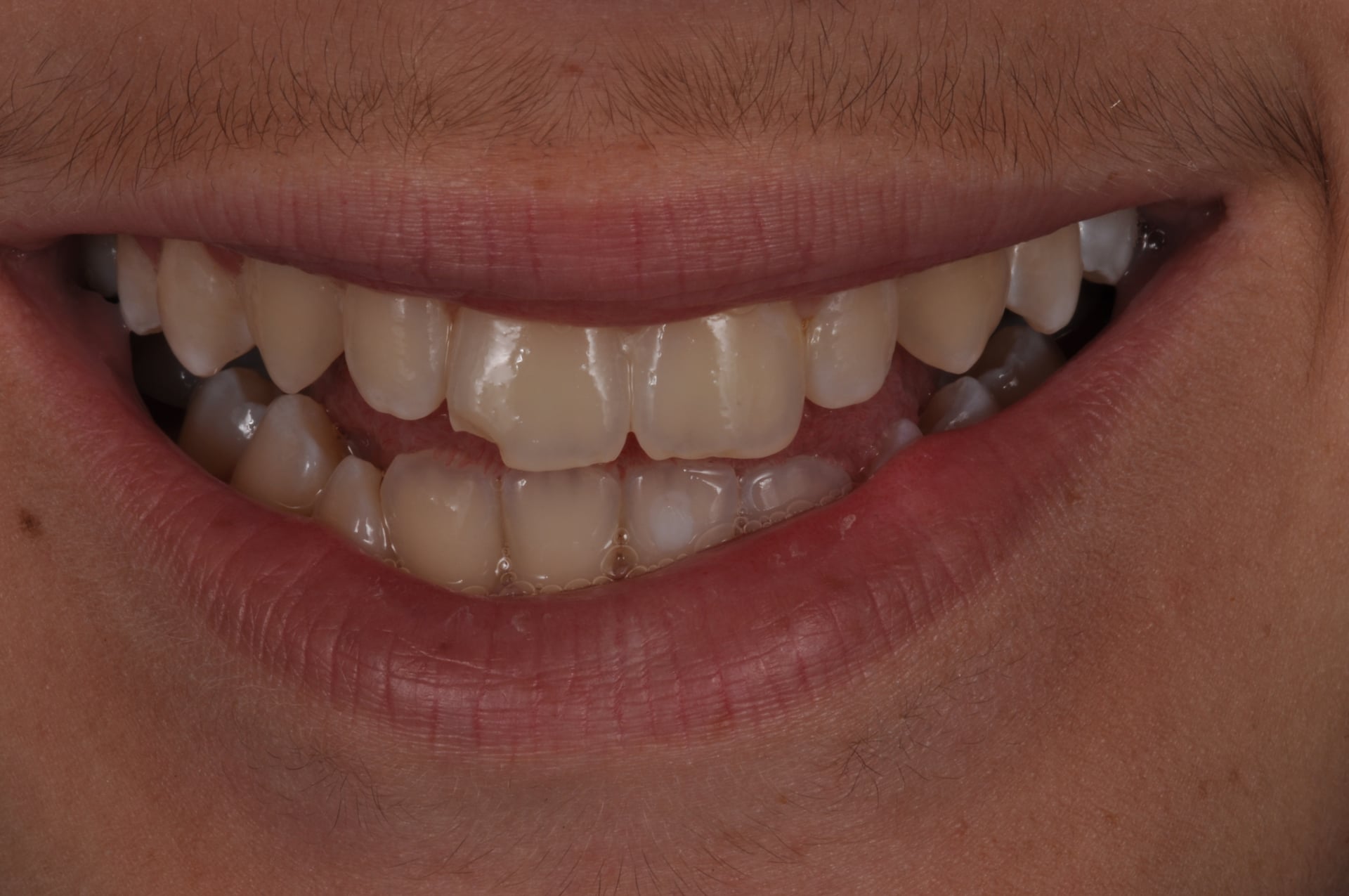 Before — Chipped Tooth Cosmetic Bonding