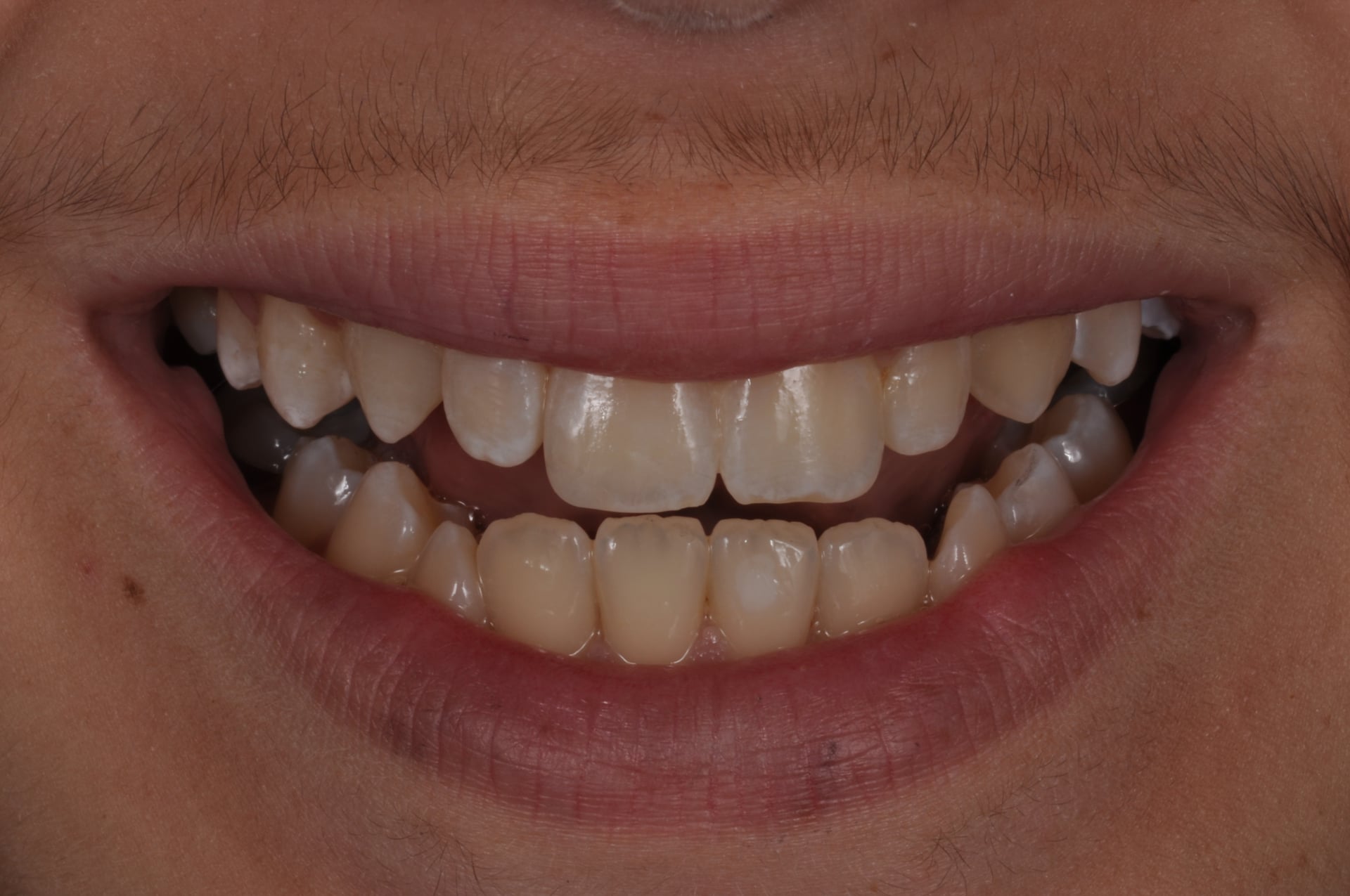 After — Chipped Tooth Cosmetic Bonding