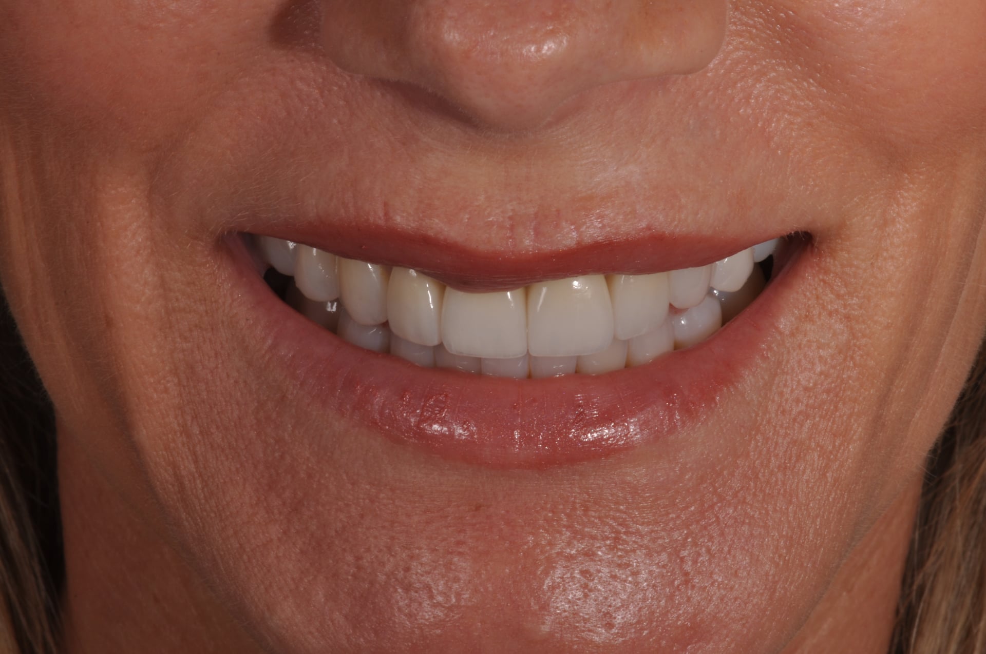 After — Porcelain Veneer Smile Makeover