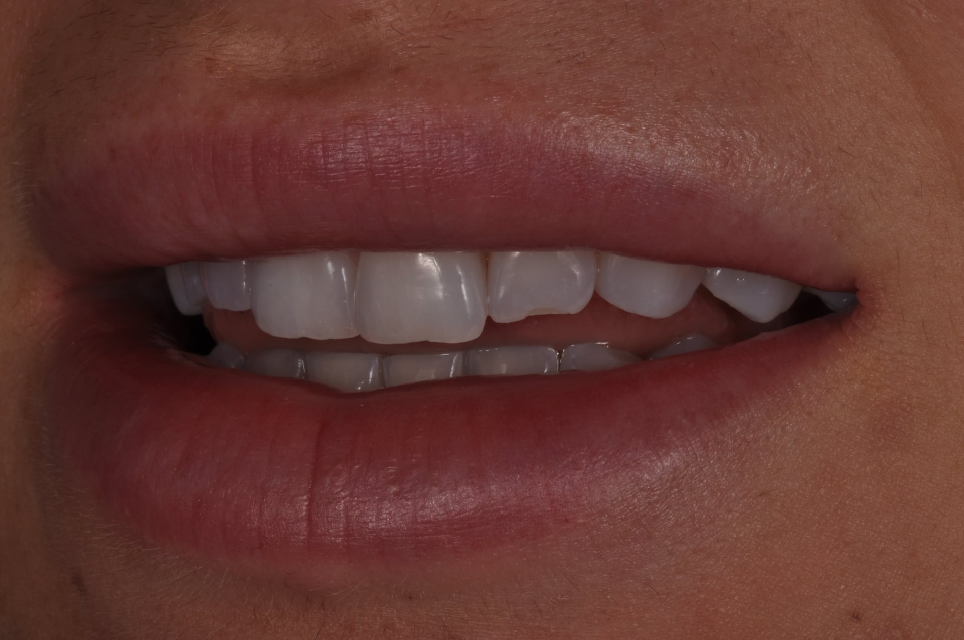Before — Porcelain Veneer for Chipped Front Tooth