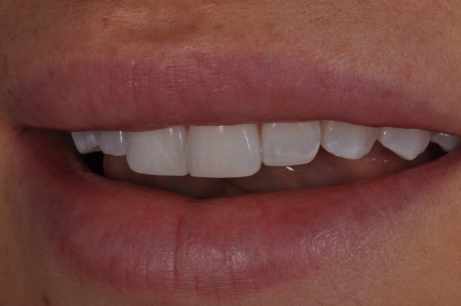 After — Porcelain Veneer for Chipped Front Tooth