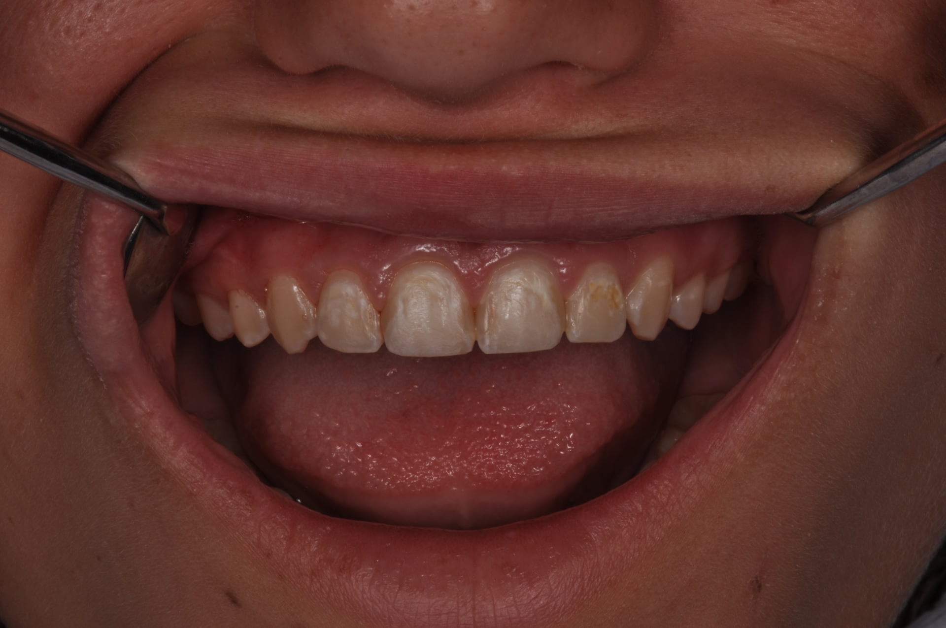 Before — White Spot Cosmetic Treatment
