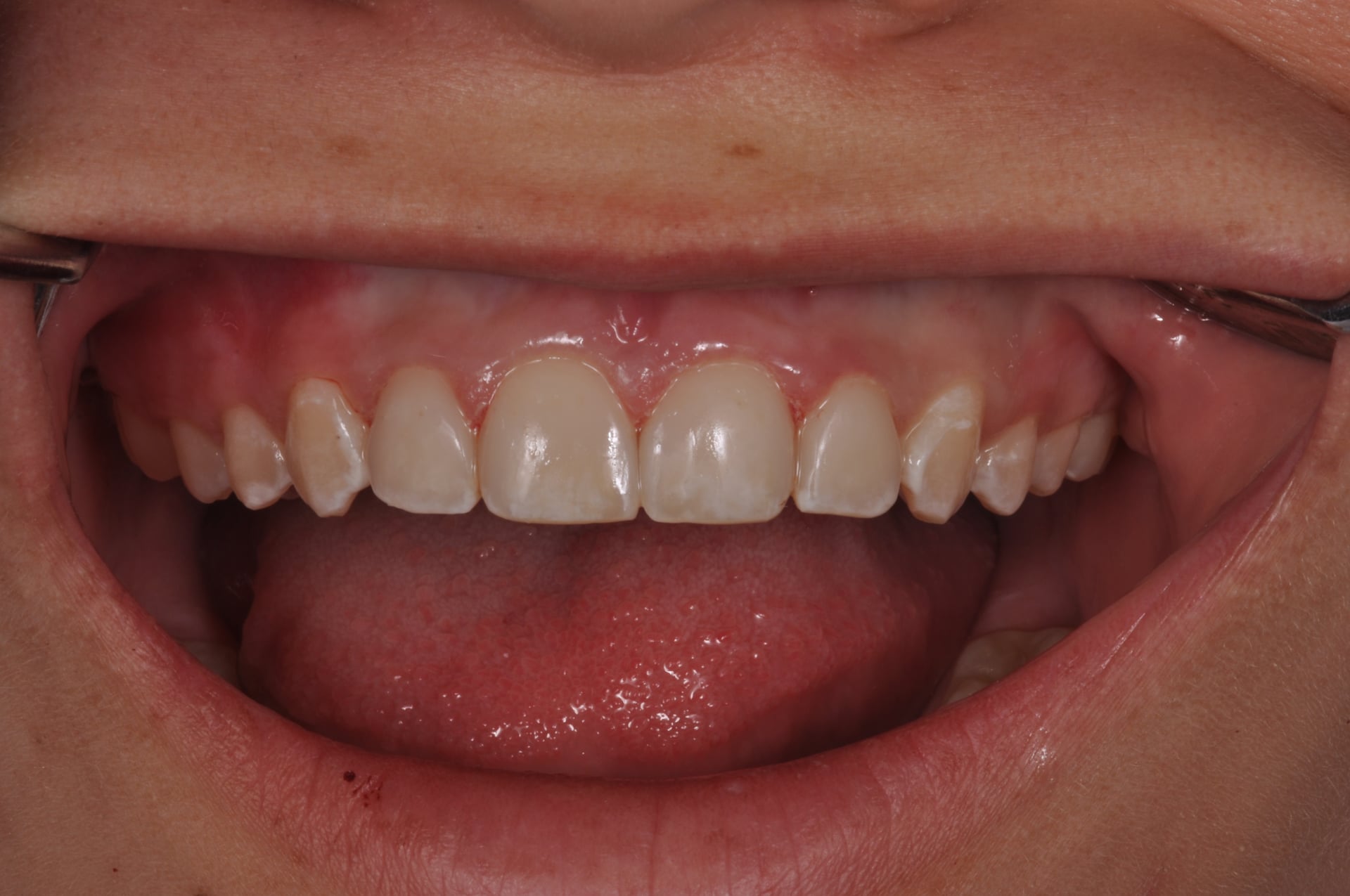 After — White Spot Cosmetic Treatment
