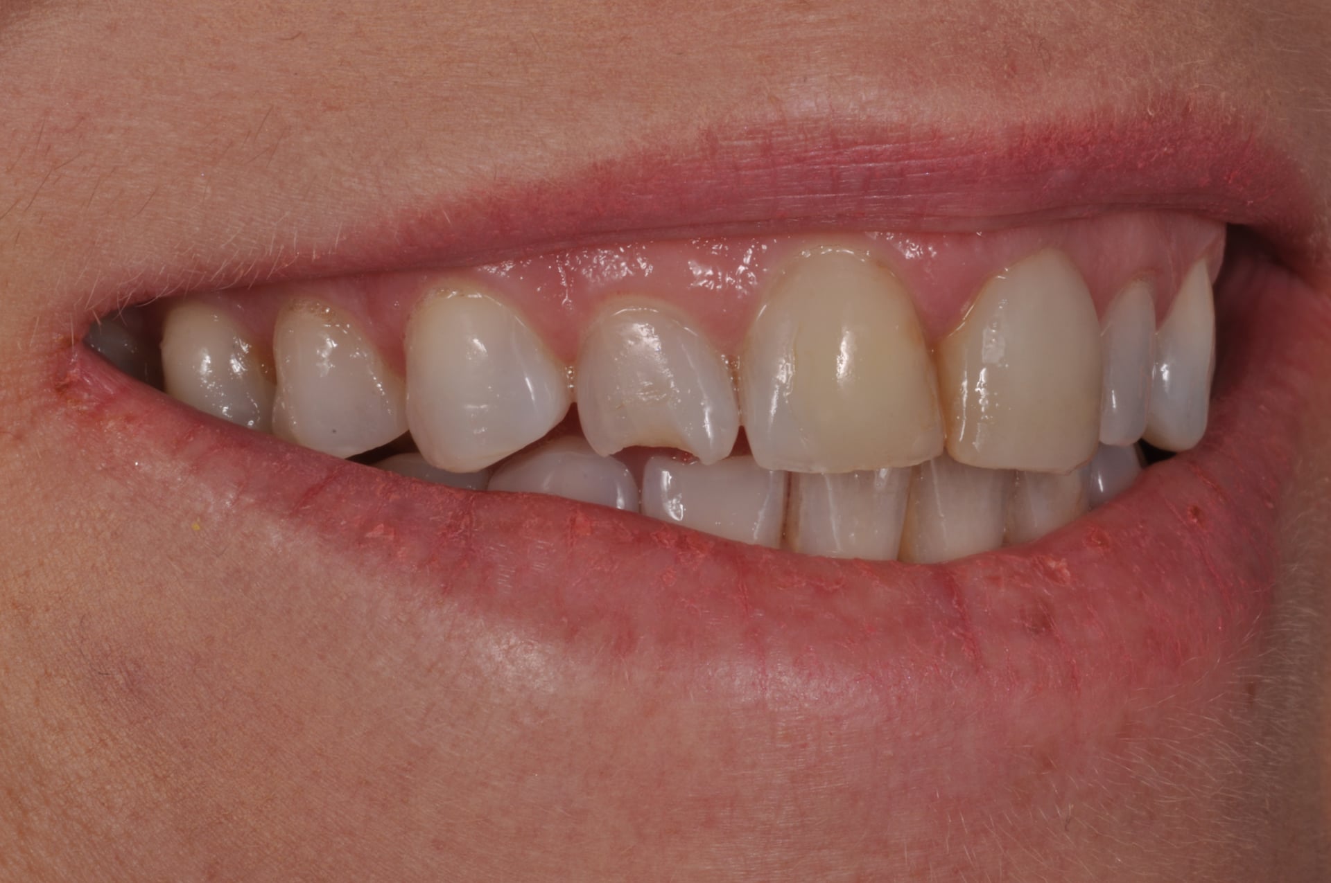 Before — Anterior Cosmetic Smile Treatment
