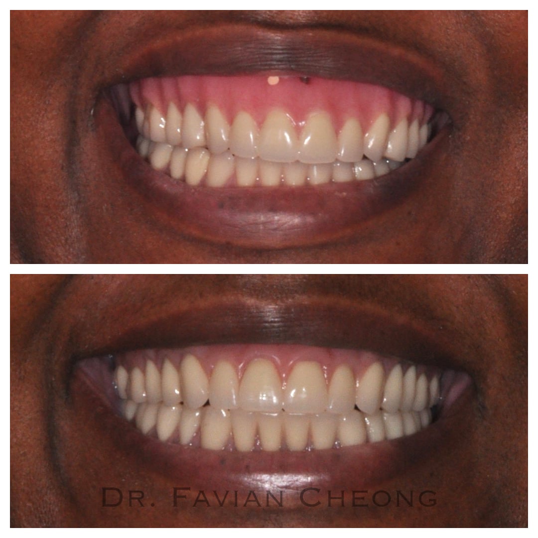 Result — Complete Denture Smile Transformation