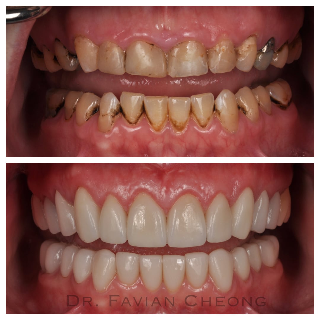 Result — Full Arch Smile Transformation