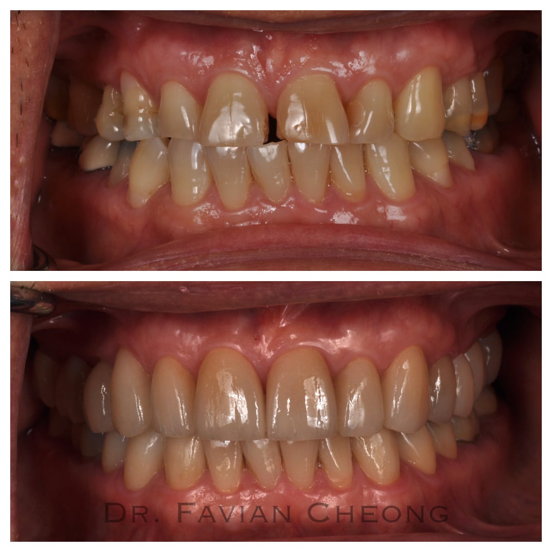 Result — Anterior Porcelain Veneers