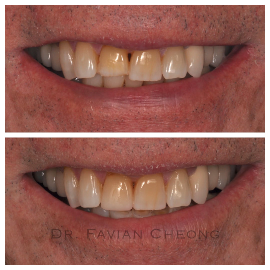 Result — Full Mouth Smile Restoration