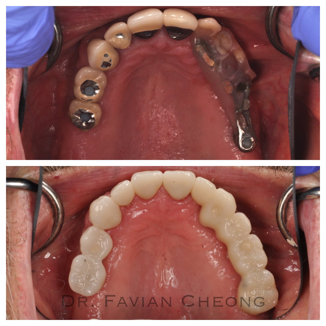 Result — Full Arch Restoration Comparison