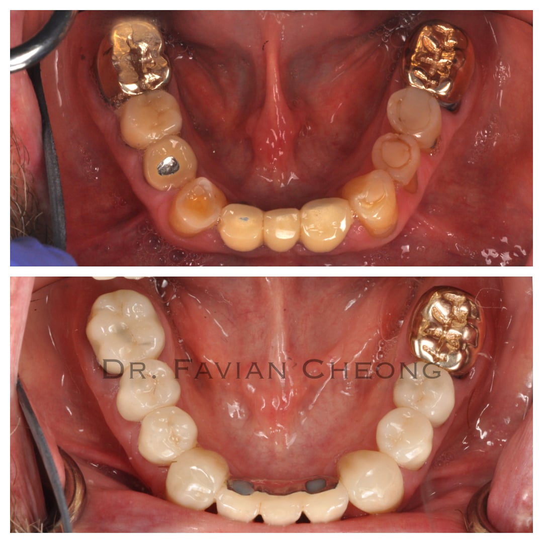 Result — Mandibular Full Arch Restoration