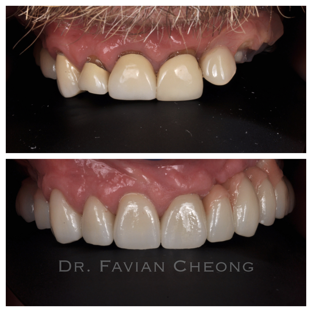Result — Complete Denture Transformation