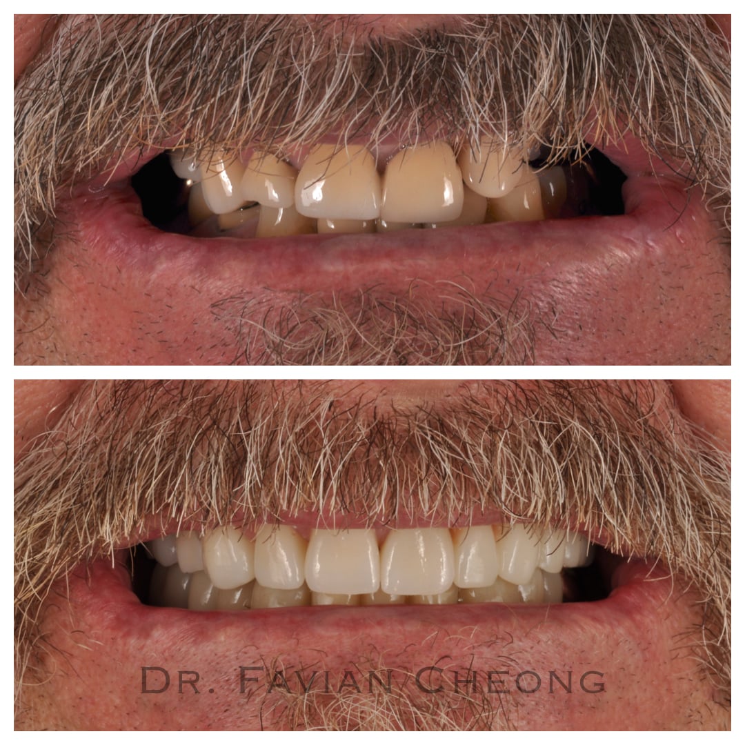 Result — Full Arch Before and After