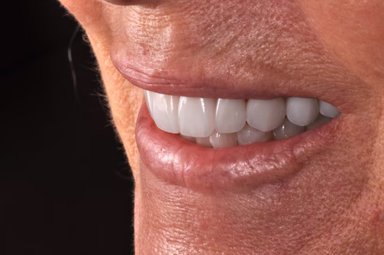 Before and after dental implant restoration at Huntington Beach Prosthodontics