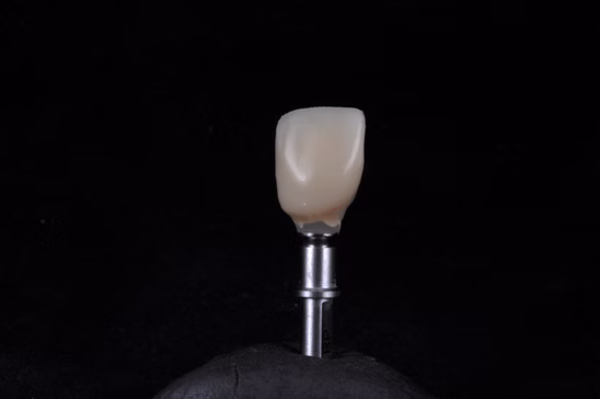 Patient dental restoration outcome