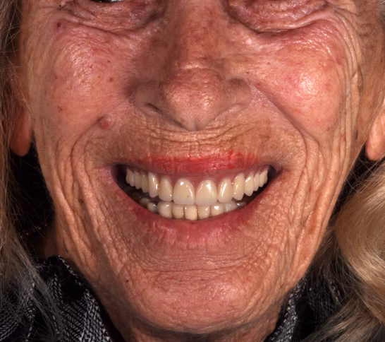 Implant restoration patient result