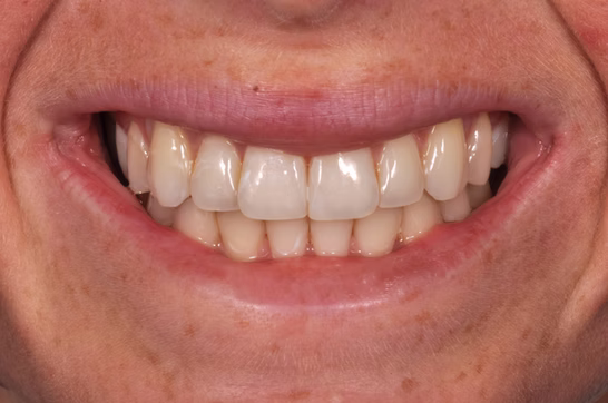 Full mouth reconstruction result with implant-supported crowns and bridges